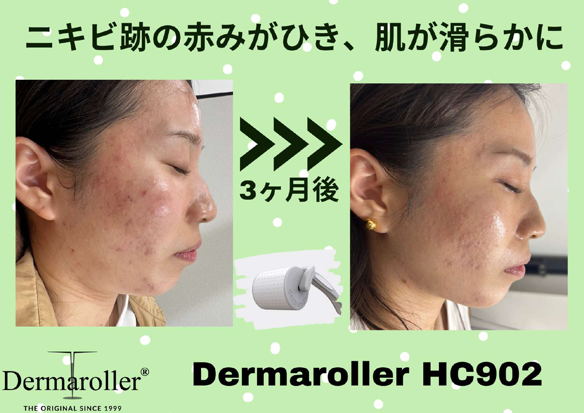 DermarollerBeforeAfter