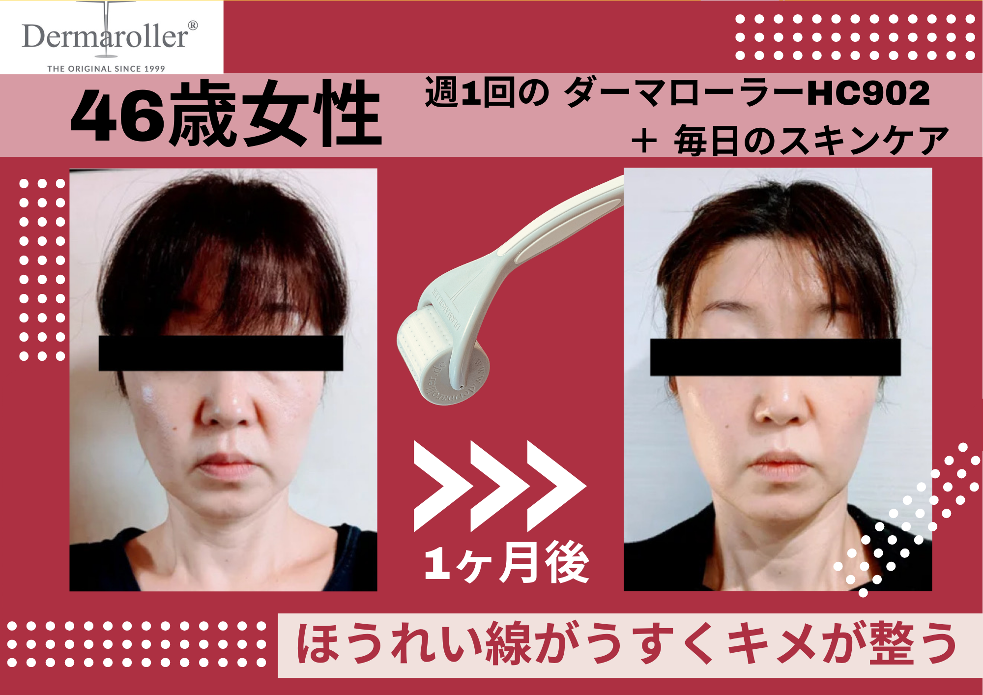 DermarollerBeforeAfter